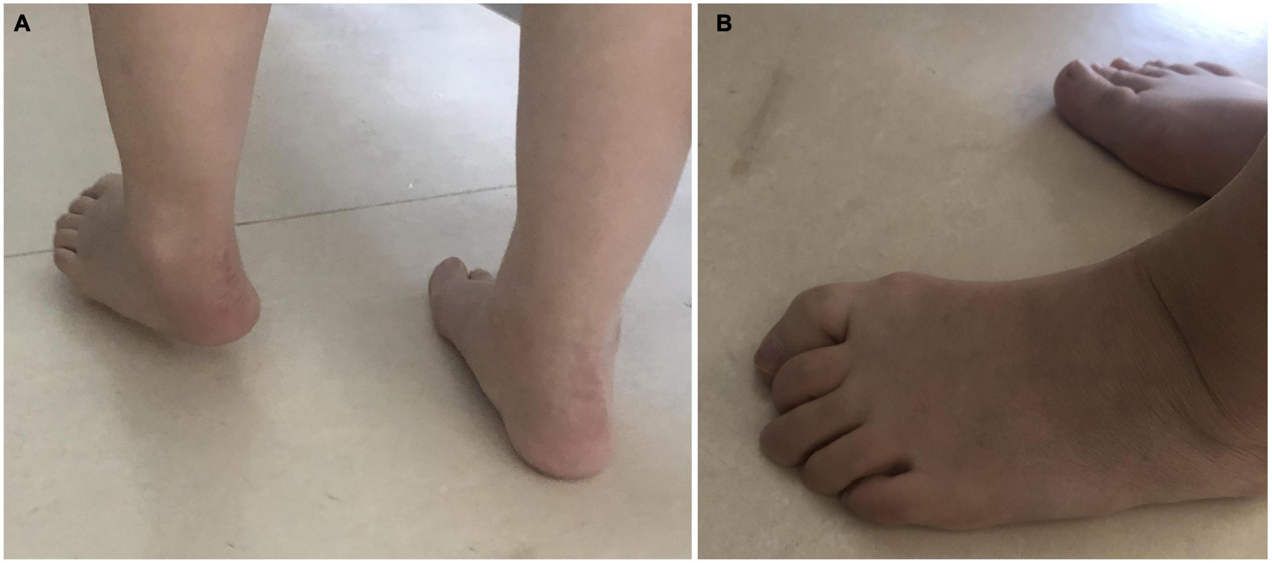 Efficacy on gait and posture control after botulinum toxin A injection for lower-limb spasticity treatment after stroke: A randomized controlled trial
